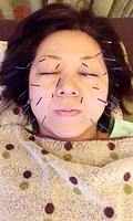 美顔鍼施術の様子